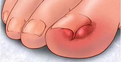 Вросший ноготь