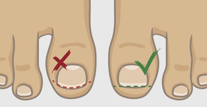 Профилактика вросших ногтей