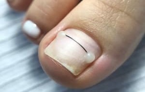 Лечение вросших ногтей